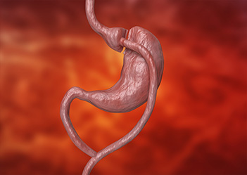 ROUX-EN-Y -Y GASTRIC BYPASS