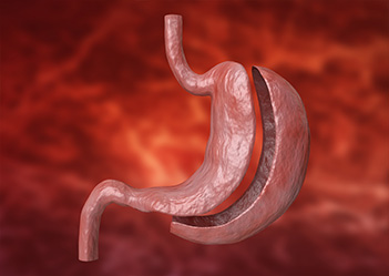 Sleeve Gastrectomy